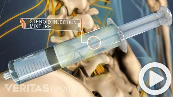 Pikes Peak Spine and Joint Epidural Steriod Injections