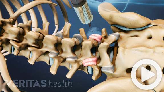 Pikes Peak Spine and Joint Medial Facet Injections